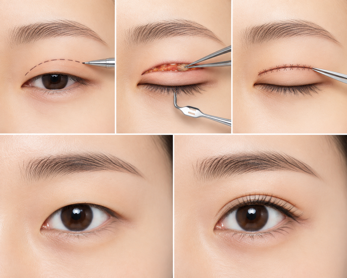 Surgeon consulting a patient about Double Eyelid Surgery